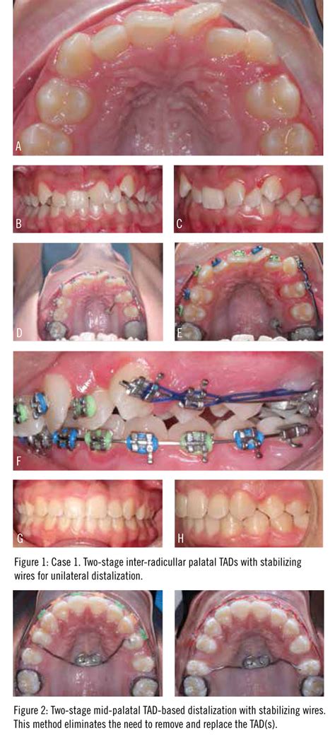 Maxillary Distalization With TADs CephTracer