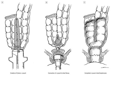 Proctectomy And Coloanal Anastomosis For Rectal Cancer Colorectal Surgery Jama Surgery