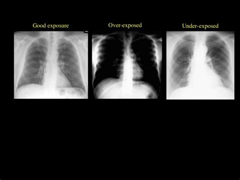 Chest X Ray Interpretation