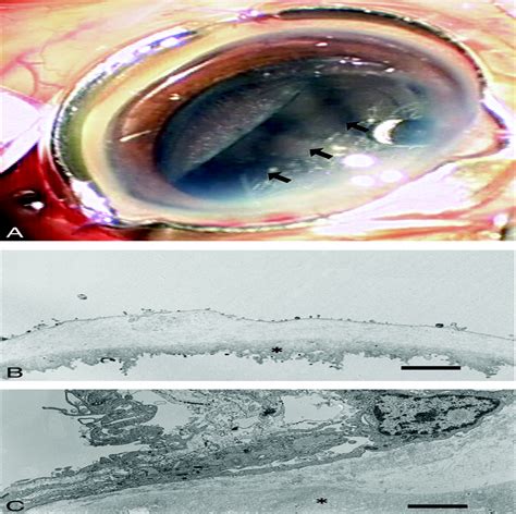 Posterior Vitreous Cortex Characteristics Of An Eye With Ast