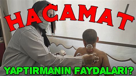 Hacamat Yapt Rman N Faydalar Hacamat Yap L Nca Ne Hissedersin