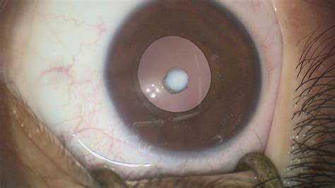 Anterior Capsular Cataract