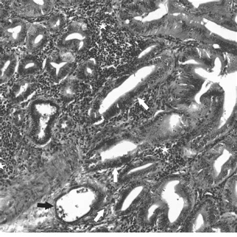 Proventriculus From 4 Week Old Broiler Chicken Diagnosed With Tvp