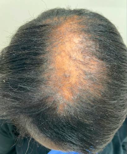 Central Centrifugal Cicatricial Alopecia Coexisting With Traction