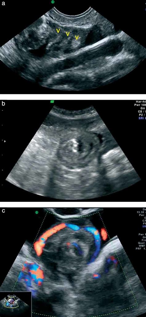 Whirlpool Sign In The Diagnosis Of Adnexal Torsion With Atypical