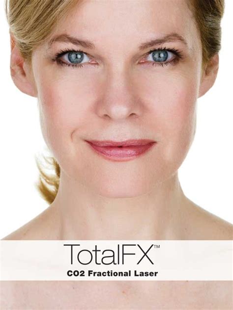 Total Fx Co2 Fractional Laser Dr Michael J Paciorekdr Michael J Paciorek