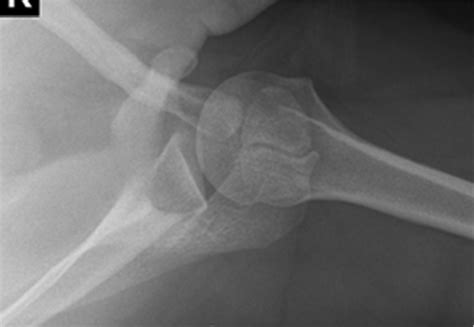 2 Arthroscopic Acromioclavicular Joint Resection Musculoskeletal Key