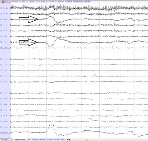 Eye movements artifact - EEGpedia