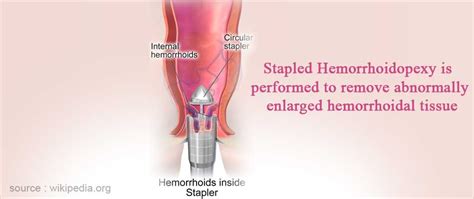 Hemorrhoidectomy Preparation Procedure Risk And Complications