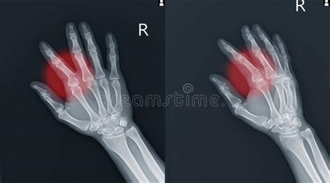 Right Wrist And Hand X Ray PA View Showing Intra Articular Comminuted