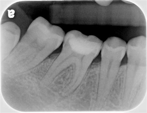Periapical X Ray