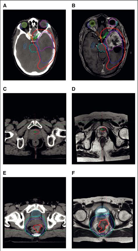 Figure 2 From The Promise Of Magnetic Resonance Imaging In Radiation