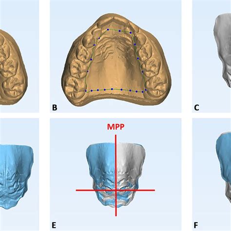 Digital Workflow For The Analysis Of Maxillary Models From Intraoral