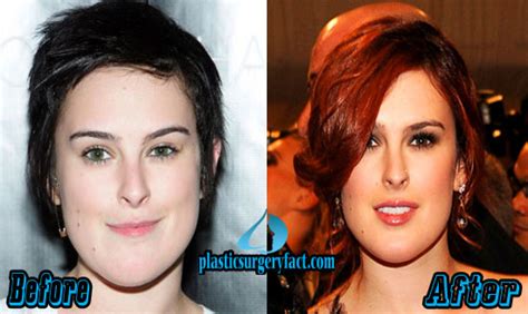 Rumer Willis Plastic Surgery Before and After Pictures