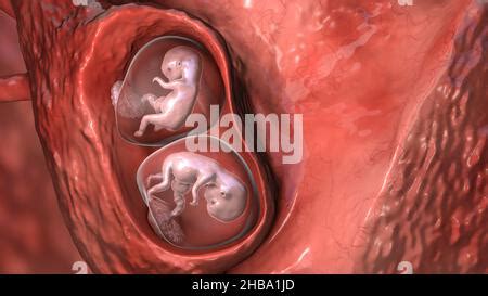 Multiple Pregnancy Illustration Monozygotic Twins In The Uterus