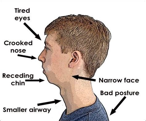 Mouth Breathing Can Change Your Childs Appearance Myofunctional