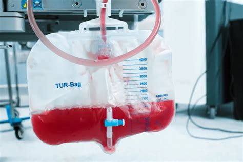 Blood In The Urine Treatment Birmingham Blood In Pee Private Clinic