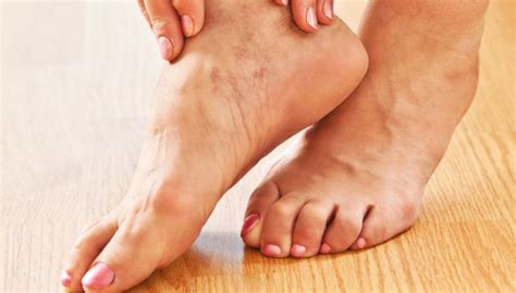 Varices De Beste Tips Om Te Voorkomen Pedicuregroep