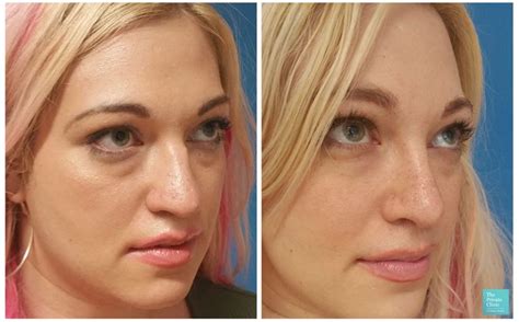 Rhinoplasty Nose Job Top Doctors Uk Best Nose Surgeons For Rhinoplasty