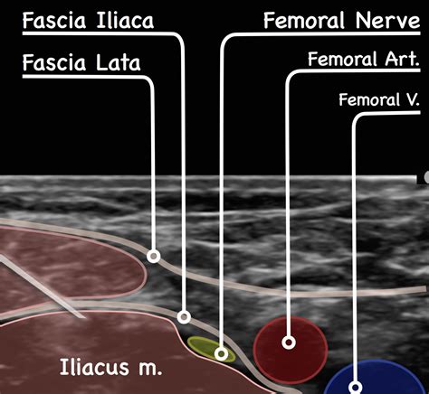 Fascia Iliaca Block Fib Uk