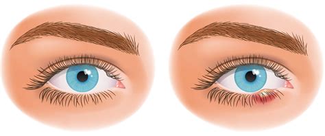 Chalazion Healing Signs Symptoms And Treatment Options