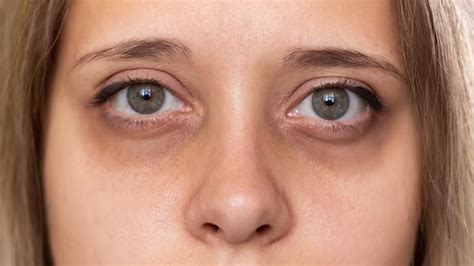 Eye Thyroid Symptoms Treatment