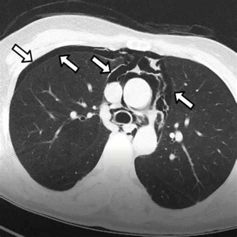 postoperative diagnostic oral opaque thorax tomography pneumothorax