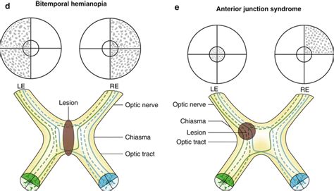 Types Of Homonymous Visual Field Defects Springerlink