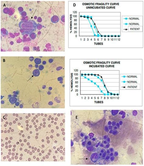 Clinical Presentation Of Parvovirus B Infection In Adults Living With