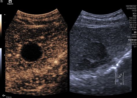 Zufallsbefund Gutartige Leberl Sion Sonographieatlas Erlangen