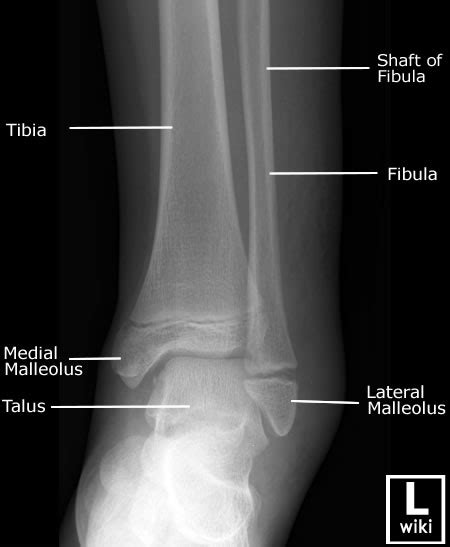 Ankle x-rays