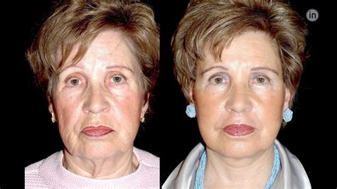 Face lift Clinica Ibérico Nogueira