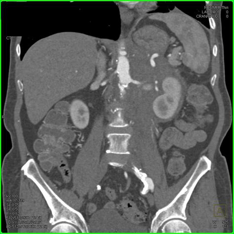 Infiltration Of The Left Pararenal Space Due To Lymphoma Kidney Case