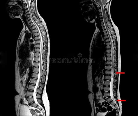 Lumbar Spine Mri Labeled