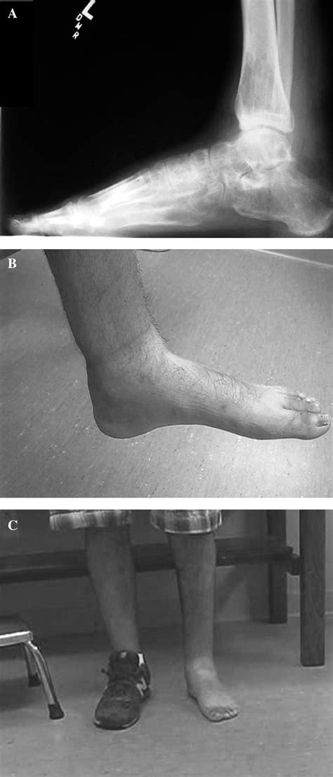 Figure 5 from Correction of Rigid Equinovarus Deformity Using a ...