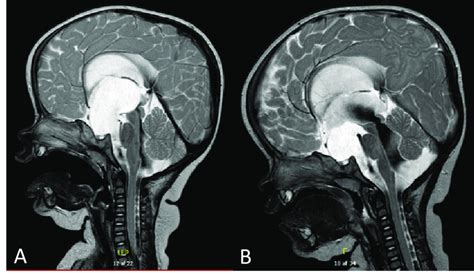 T2 Weighted Mri Scans At Time Of Diagnosis For Both Twins A And B Download Scientific Diagram