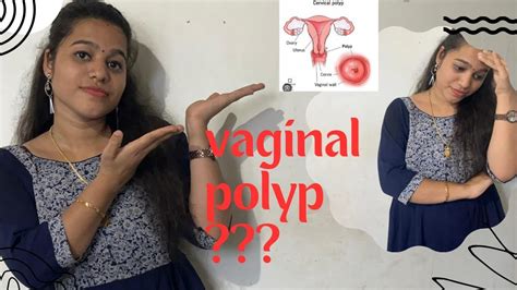 Vaginal Polypandtreatment Caues Cancer Youtubevideo Health