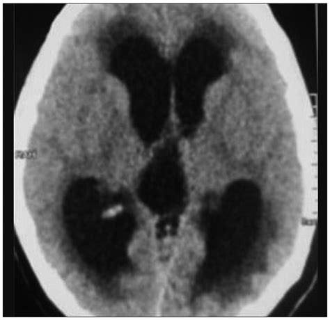 Hydrocephalus On CT Scan