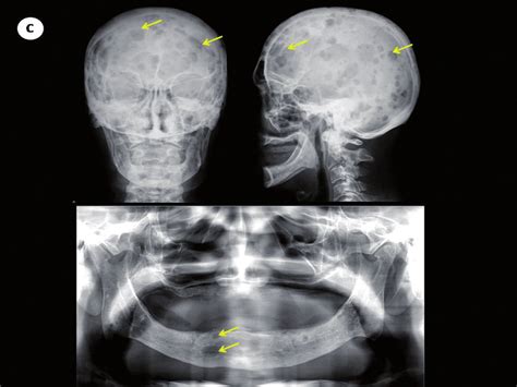 C Digital Panoramic Radiographic Evaluation Showing Punched Out Download Scientific Diagram