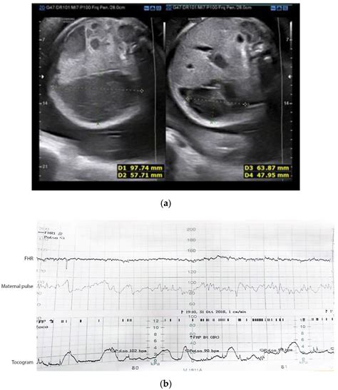 JCM Free Full Text Case Series Of Acute Meconium Peritonitis