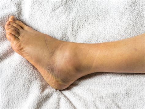 What Causes Swollen Feet And Ankles 57 Off