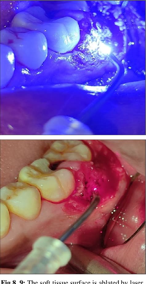 Figure From A Laser Assisted Approach To Treat Fibroepithelial