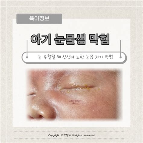 신생아 눈꼽 식염수 제거 아기 눈물샘 막힘 경험담 네이버 블로그