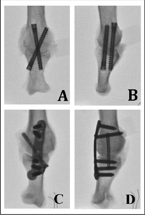 Figure From Biomechanical Comparison Of Low Profile Contoured Locking