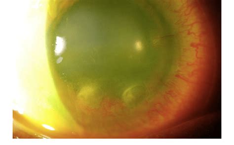 Corneal Pannus And Ulceration Secondary To Limbal Stem Cell Deficiency