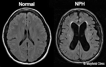 Normal Pressure Hydrocephalus | Briz Brain & Spine