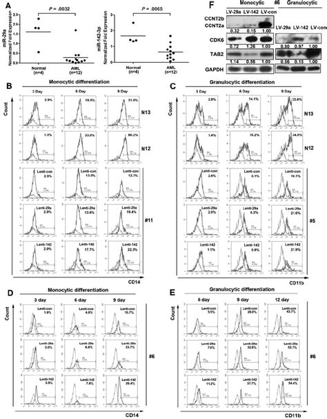 Expression Of MiR 29a And MiR 142 3p In AML BM Blasts And Their