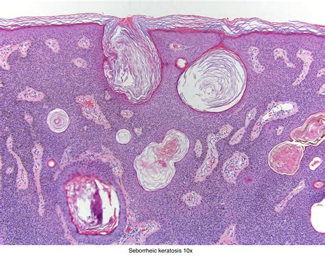 Verrucous Seborrheic Keratosis Histology | Images and Photos finder