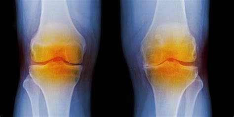 5 Natural Osteoarthritis Treatments What Is Osteoarthritis