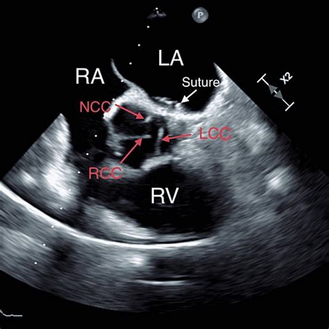 Mid Esophageal TEE Aortic Valve Short Axis View Showing Aortic Annulus